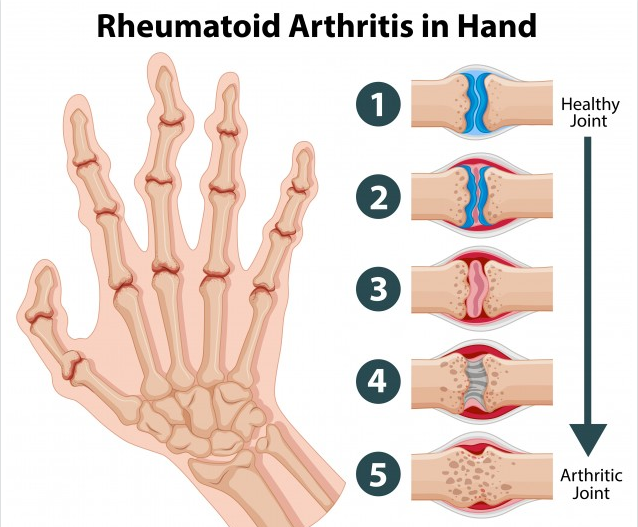 arthritis